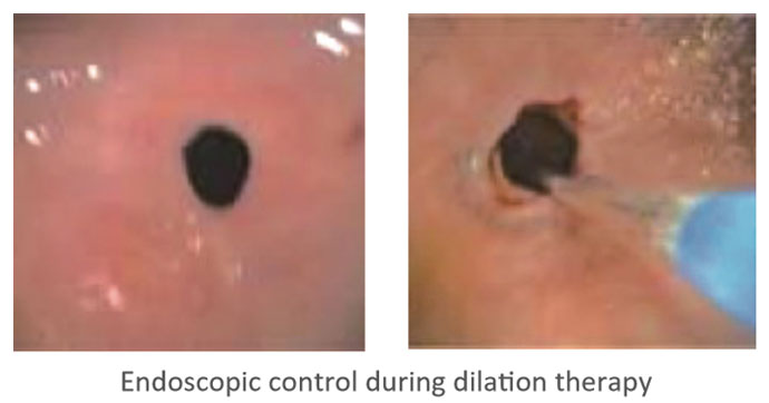 Wire Guided Single-Stage Balloons Wire Guided Single-Stage Balloons